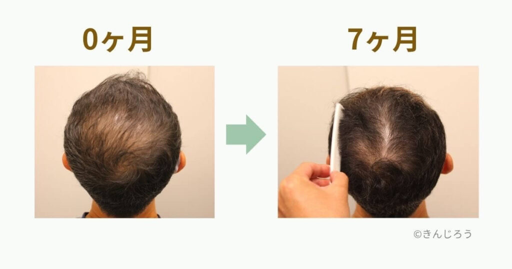 AGA治療0ヶ月と7ヶ月の頭頂部比較写真|フィナステリドとミノキシジル内服の経過記録